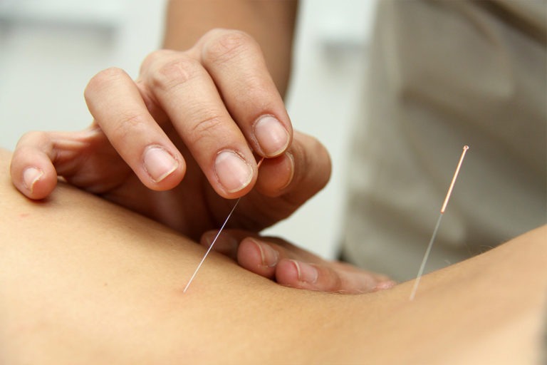 Acupuncture