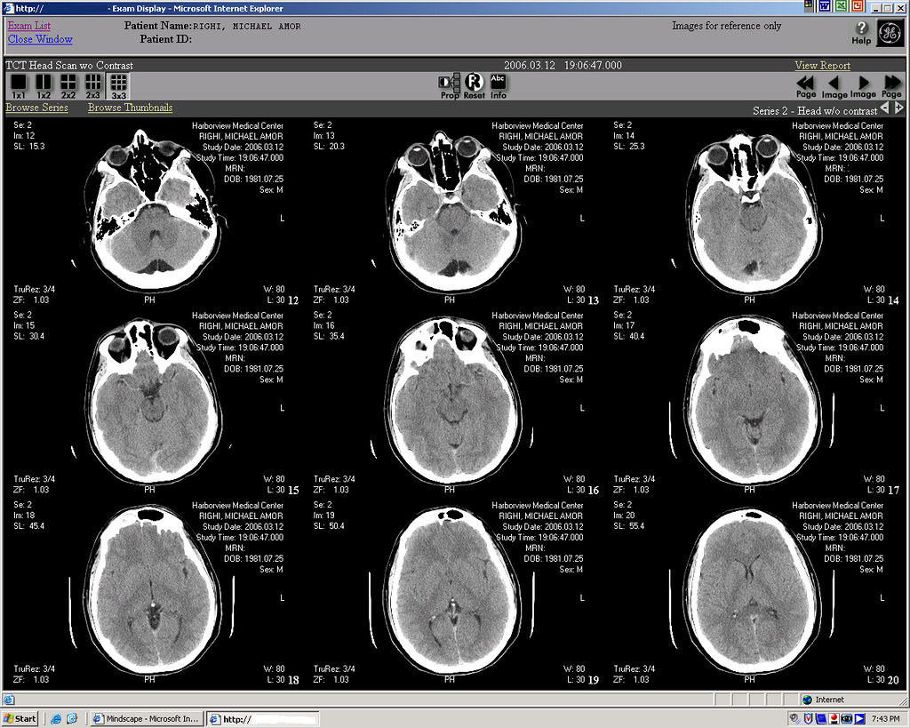 New Hope for Diagnosing CTE in Living Patients