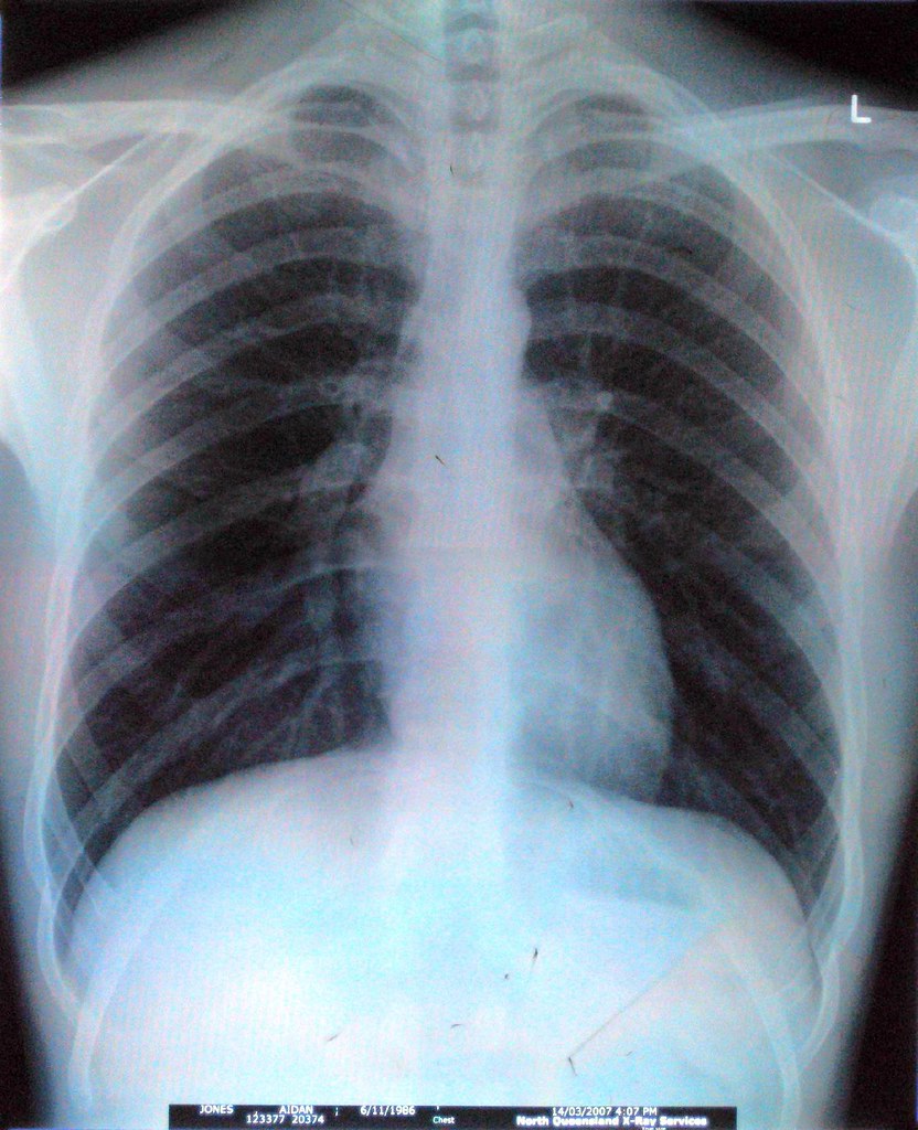 Image: Aidan Jones, BY-SA 2.0 (via Openverse). Rare Gene Tied to Lung Cancer Risk in Never-Smokers