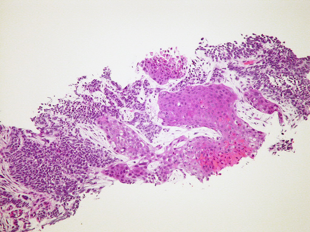 Scientists Untangle Biology of ‘Undruggable’ Cancer Gene